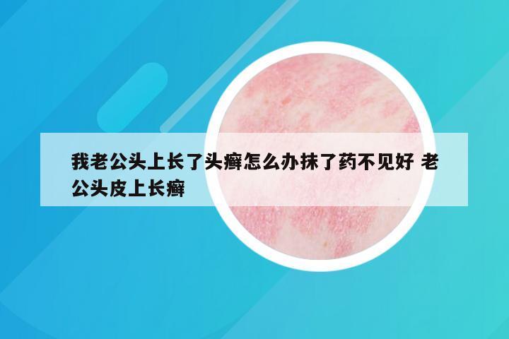 我老公头上长了头癣怎么办抹了药不见好 老公头皮上长癣