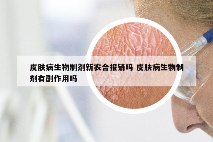 皮肤病生物制剂新农合报销吗 皮肤病生物制剂有副作用吗