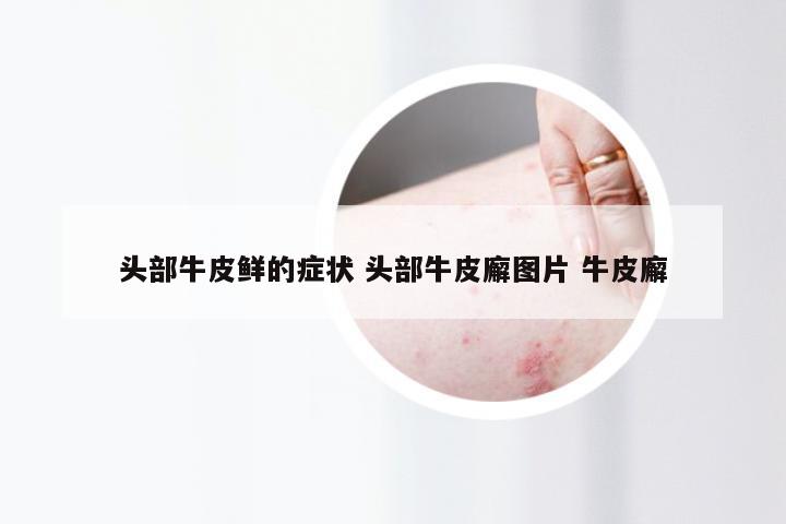 头部牛皮鲜的症状 头部牛皮廨图片 牛皮廨