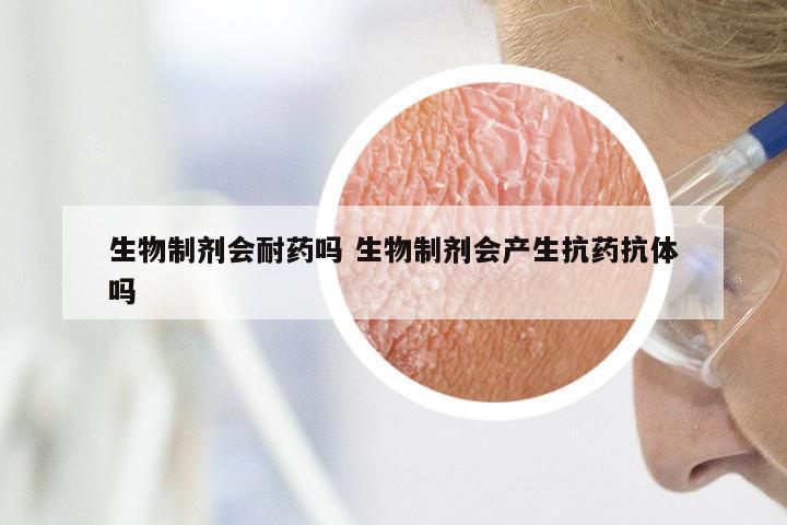 生物制剂会耐药吗 生物制剂会产生抗药抗体吗