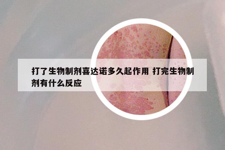 打了生物制剂喜达诺多久起作用 打完生物制剂有什么反应