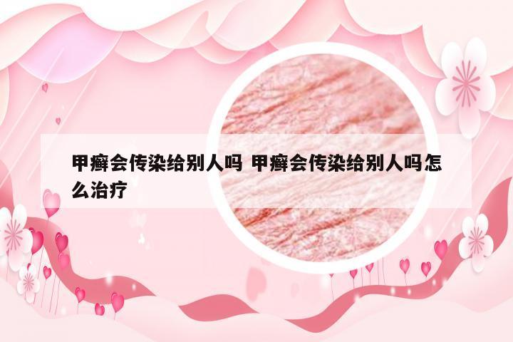 甲癣会传染给别人吗 甲癣会传染给别人吗怎么治疗