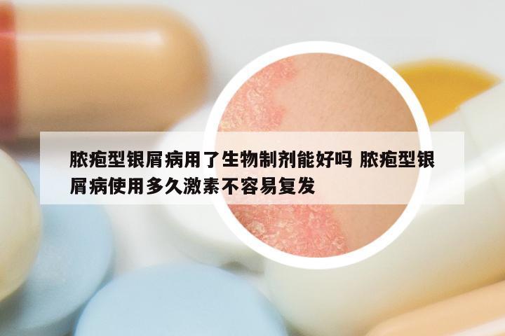 脓疱型银屑病用了生物制剂能好吗 脓疱型银屑病使用多久激素不容易复发