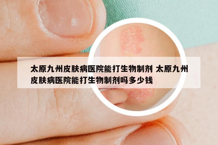 太原九州皮肤病医院能打生物制剂 太原九州皮肤病医院能打生物制剂吗多少钱