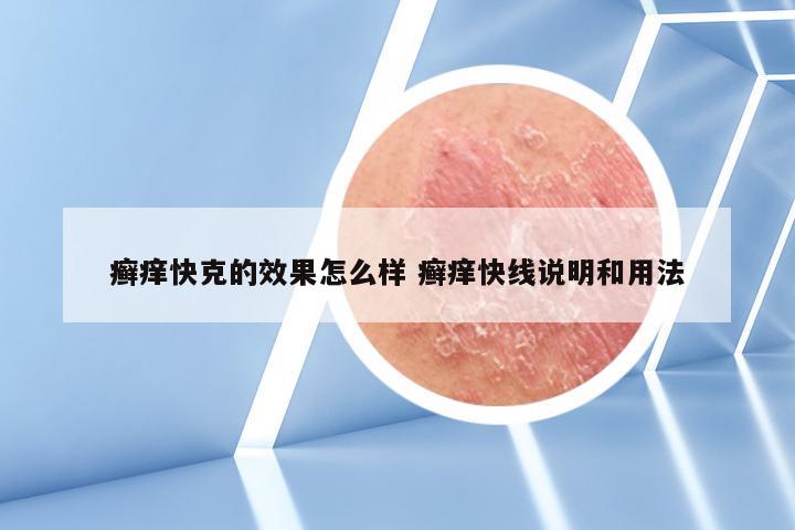 癣痒快克的效果怎么样 癣痒快线说明和用法