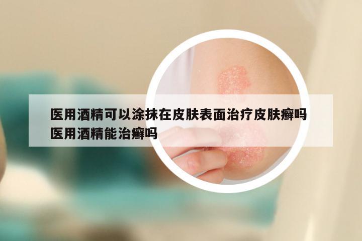 医用酒精可以涂抹在皮肤表面治疗皮肤癣吗 医用酒精能治癣吗