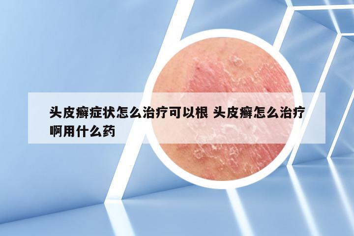 头皮癣症状怎么治疗可以根 头皮癣怎么治疗啊用什么药