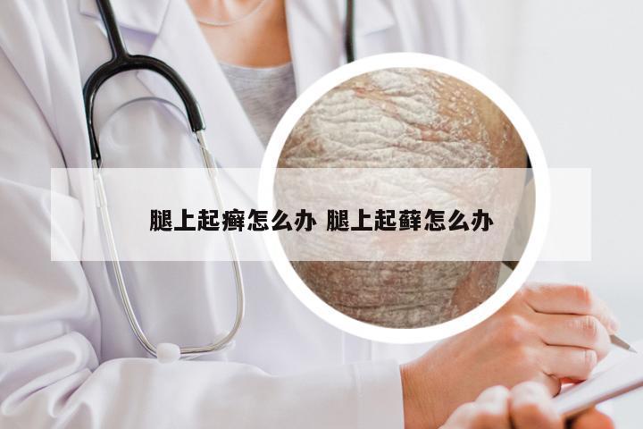 腿上起癣怎么办 腿上起藓怎么办