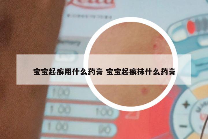 宝宝起癣用什么药膏 宝宝起癣抹什么药膏