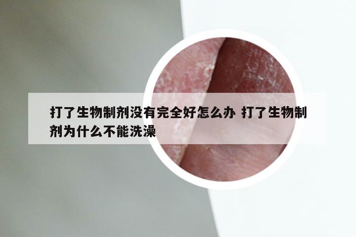 打了生物制剂没有完全好怎么办 打了生物制剂为什么不能洗澡