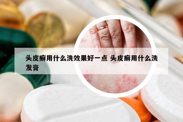 头皮癣用什么洗效果好一点 头皮癣用什么洗发膏