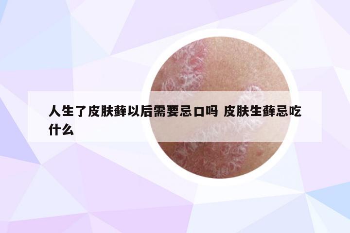 人生了皮肤藓以后需要忌口吗 皮肤生藓忌吃什么