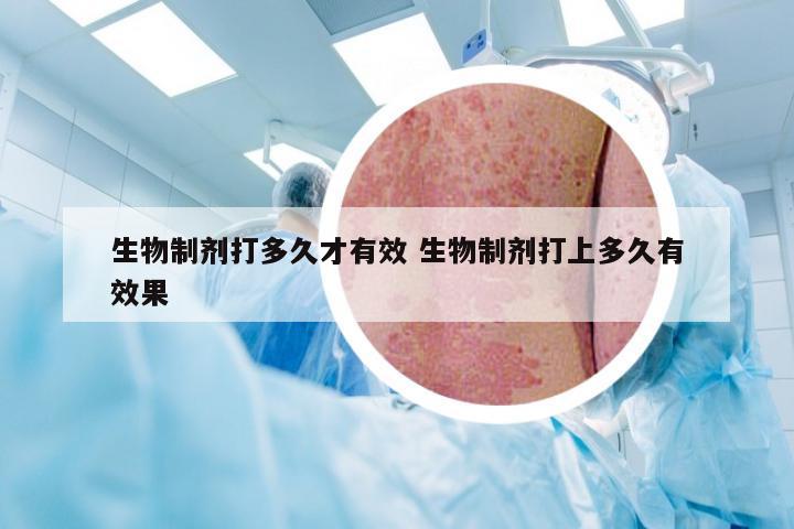 生物制剂打多久才有效 生物制剂打上多久有效果