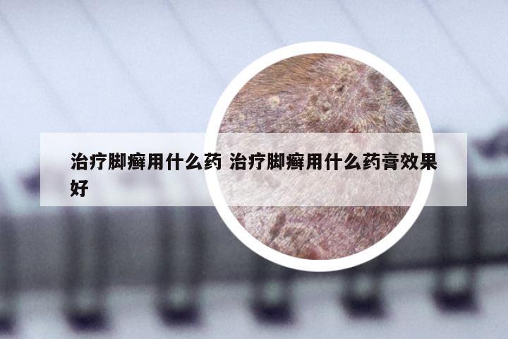 治疗脚癣用什么药 治疗脚癣用什么药膏效果好