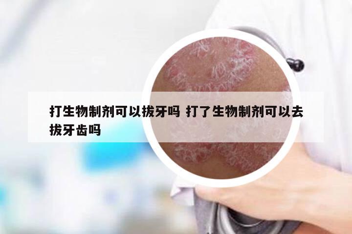 打生物制剂可以拔牙吗 打了生物制剂可以去拔牙齿吗