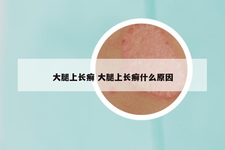 大腿上长癣 大腿上长癣什么原因