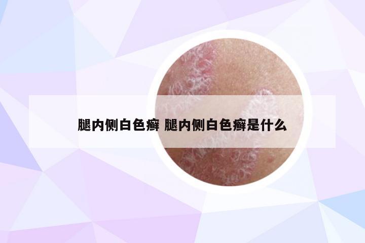 腿内侧白色癣 腿内侧白色癣是什么