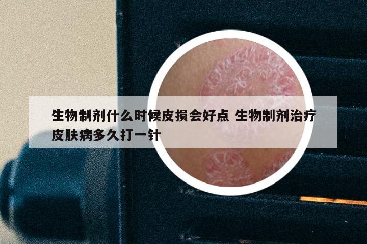 生物制剂什么时候皮损会好点 生物制剂治疗皮肤病多久打一针