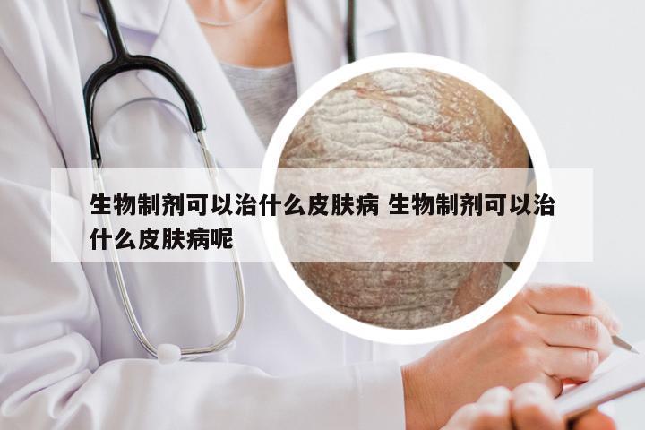 生物制剂可以治什么皮肤病 生物制剂可以治什么皮肤病呢