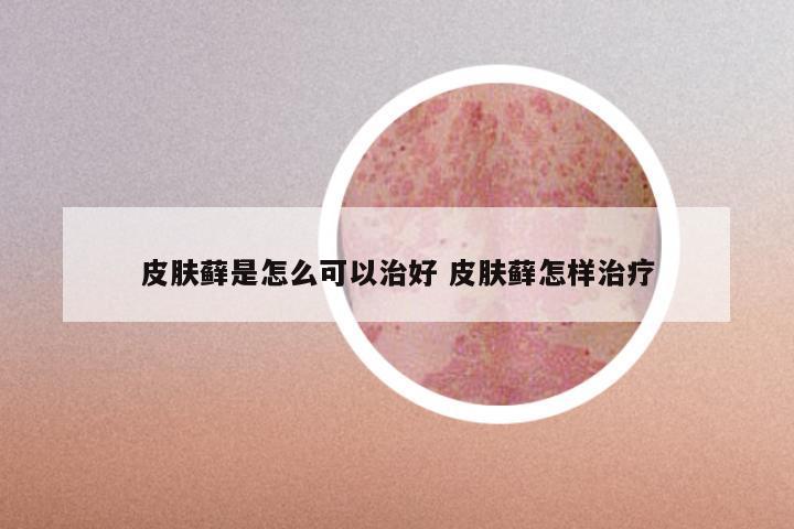 皮肤藓是怎么可以治好 皮肤藓怎样治疗