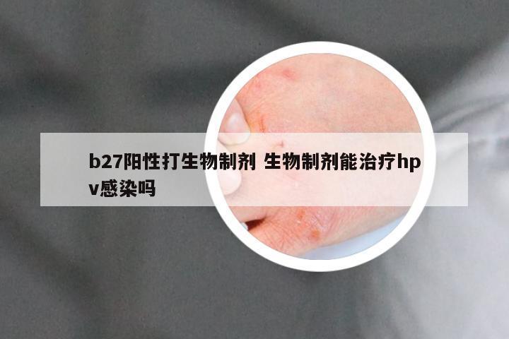 b27阳性打生物制剂 生物制剂能治疗hpv感染吗