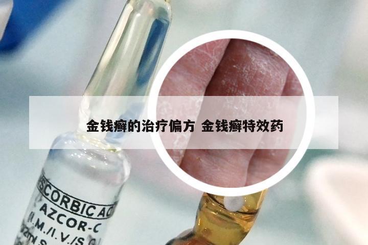 金钱癣的治疗偏方 金钱癣特效药