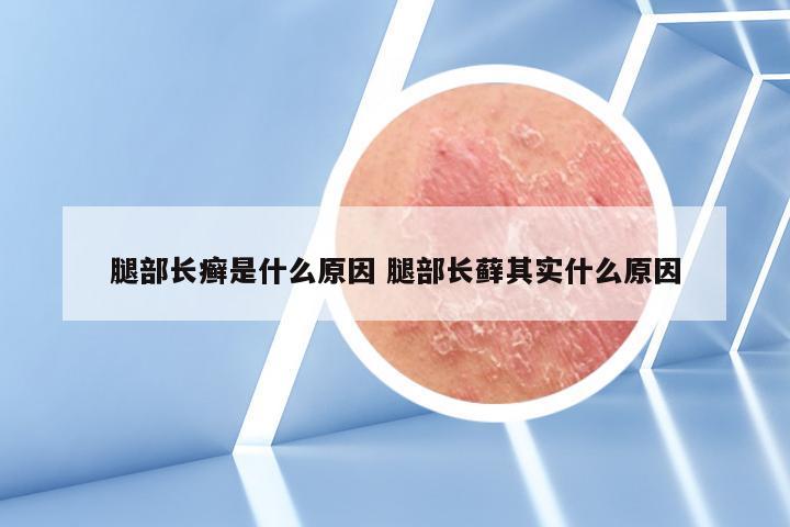 腿部长癣是什么原因 腿部长藓其实什么原因