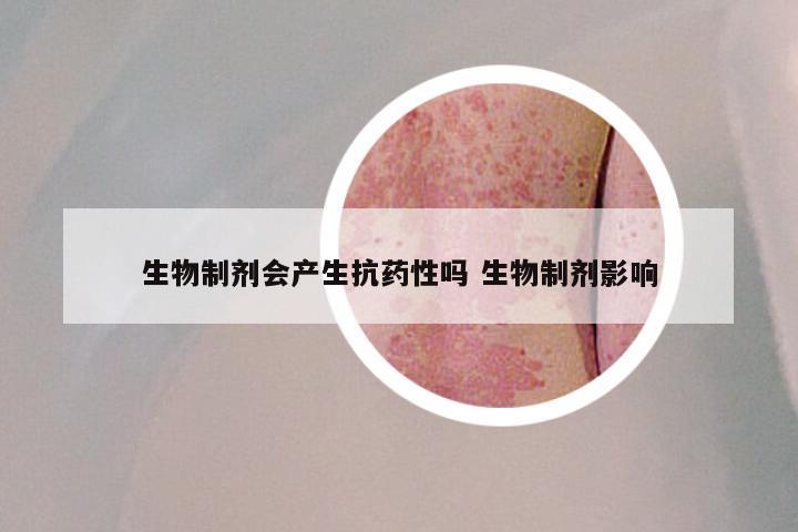 生物制剂会产生抗药性吗 生物制剂影响