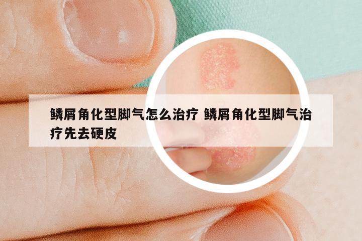 鳞屑角化型脚气怎么治疗 鳞屑角化型脚气治疗先去硬皮