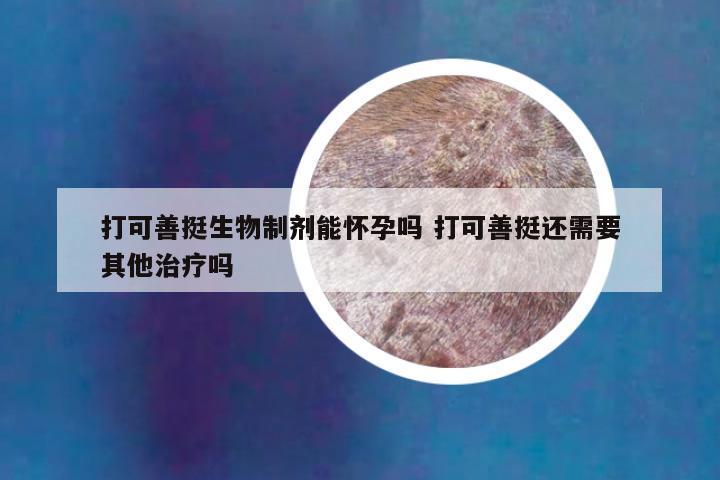 打可善挺生物制剂能怀孕吗 打可善挺还需要其他治疗吗