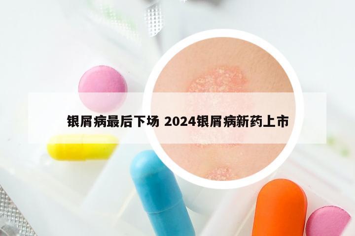 银屑病最后下场 2024银屑病新药上市