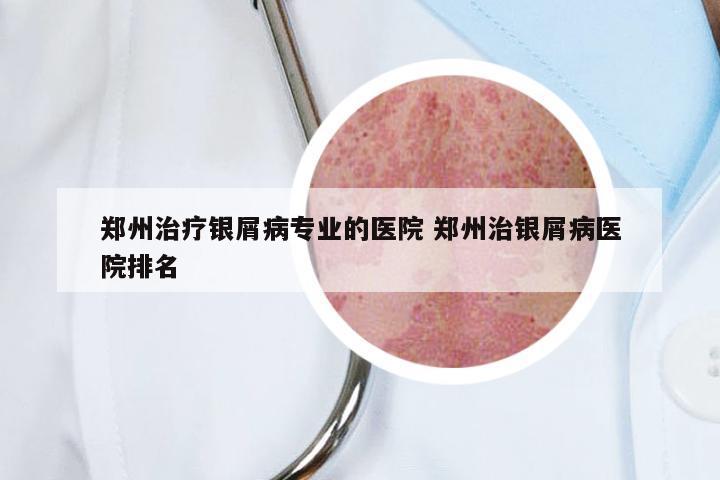 郑州治疗银屑病专业的医院 郑州治银屑病医院排名