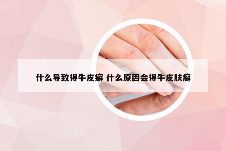 什么导致得牛皮癣 什么原因会得牛皮肤癣