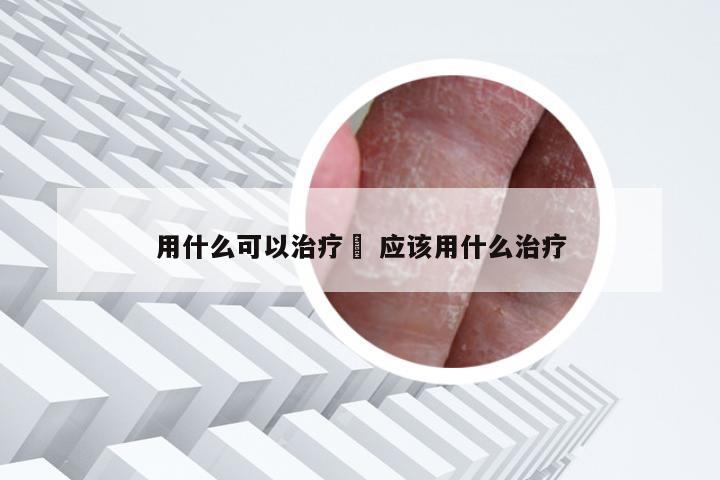 用什么可以治疗廯 应该用什么治疗