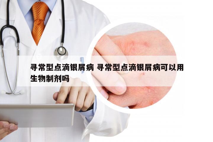 寻常型点滴银屑病 寻常型点滴银屑病可以用生物制剂吗