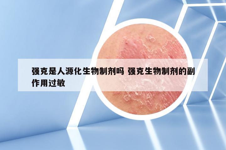 强克是人源化生物制剂吗 强克生物制剂的副作用过敏