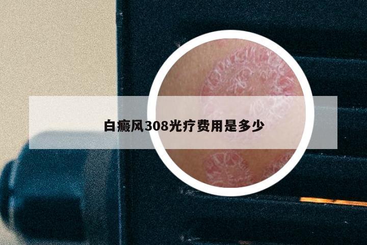 白癜风308光疗费用是多少