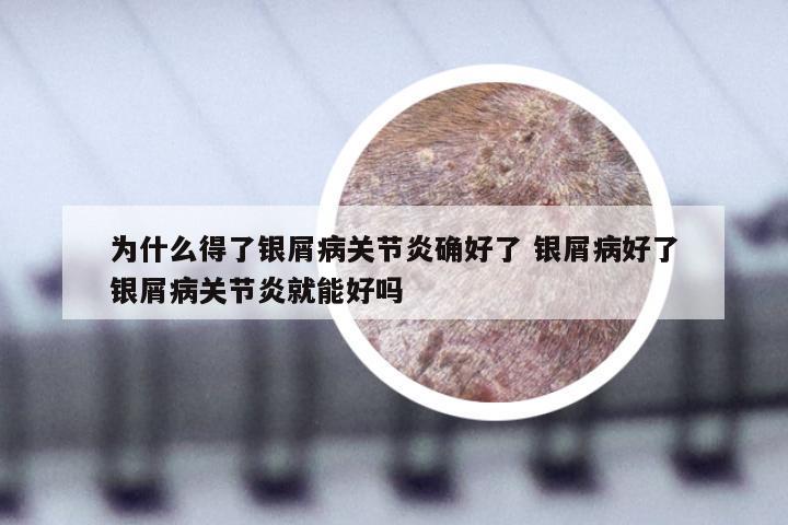 为什么得了银屑病关节炎确好了 银屑病好了银屑病关节炎就能好吗