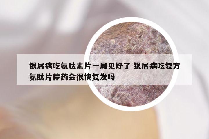 银屑病吃氨肽素片一周见好了 银屑病吃复方氨肽片停药会很快复发吗