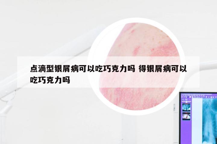 点滴型银屑病可以吃巧克力吗 得银屑病可以吃巧克力吗