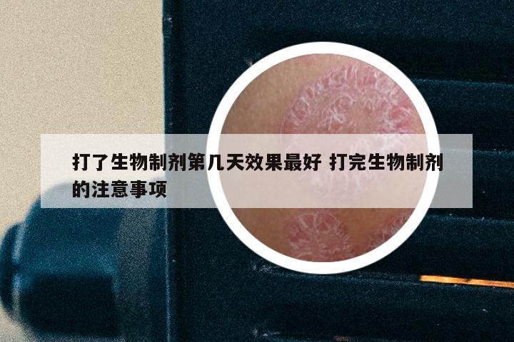 打了生物制剂第几天效果最好 打完生物制剂的注意事项