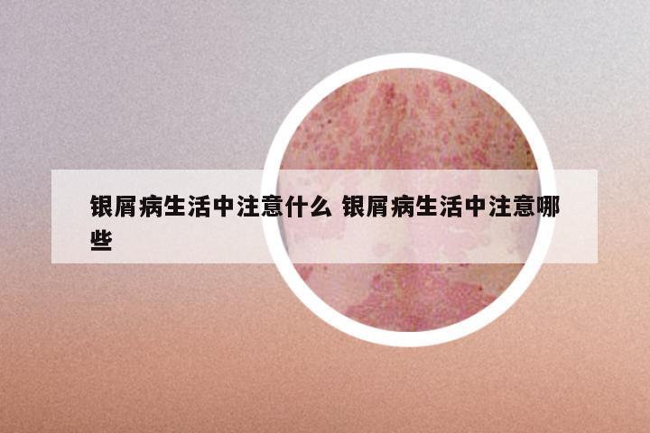 银屑病生活中注意什么 银屑病生活中注意哪些