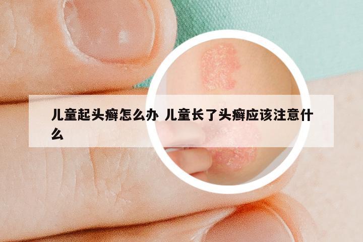 儿童起头癣怎么办 儿童长了头癣应该注意什么