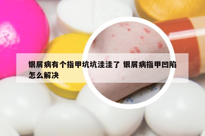 银屑病有个指甲坑坑洼洼了 银屑病指甲凹陷怎么解决