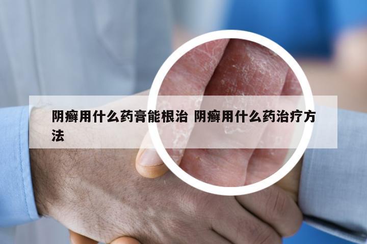 阴癣用什么药膏能根治 阴癣用什么药治疗方法