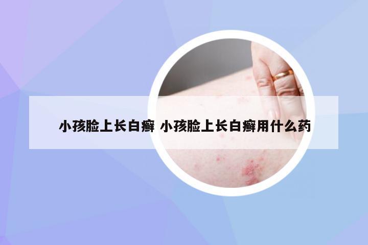 小孩脸上长白癣 小孩脸上长白癣用什么药