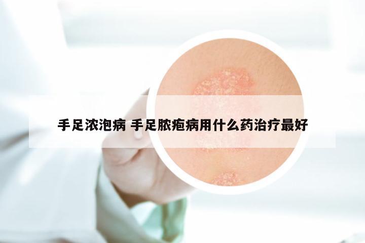 手足浓泡病 手足脓疱病用什么药治疗最好