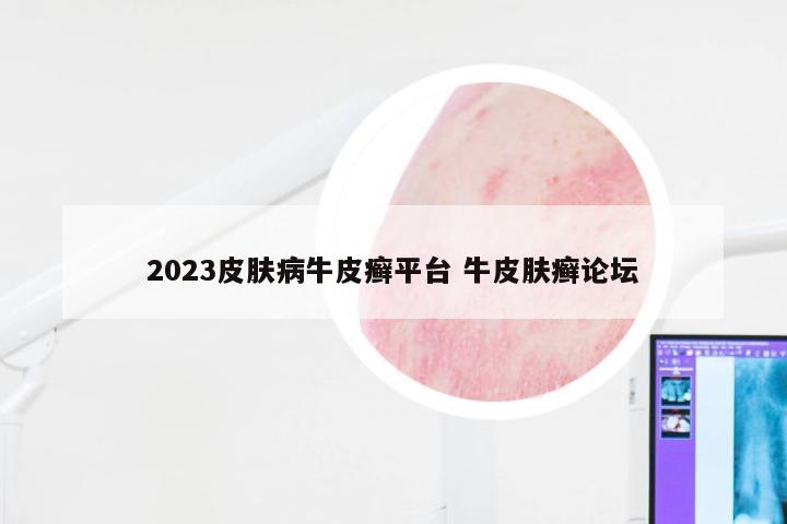 2023皮肤病牛皮癣平台 牛皮肤癣论坛