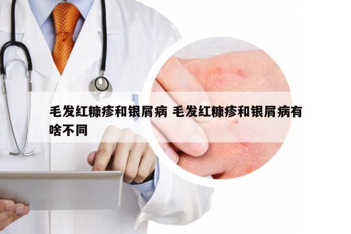 毛发红糠疹和银屑病 毛发红糠疹和银屑病有啥不同