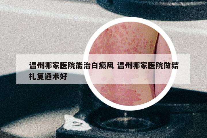 温州哪家医院能治白癜风 温州哪家医院做结扎复通术好